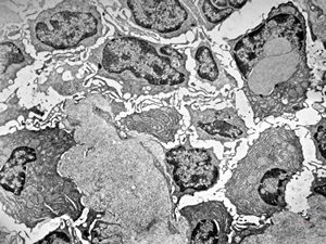 M,46y. | nuclear pseudoinclusion in plasmocyte - susp. amyloid … tonsillar tumor … Waldenström macroglobulinemia